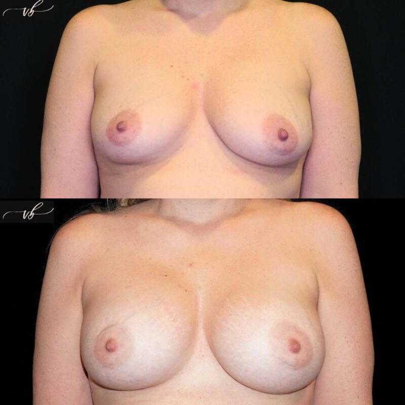 Breast augmentation before and after 1