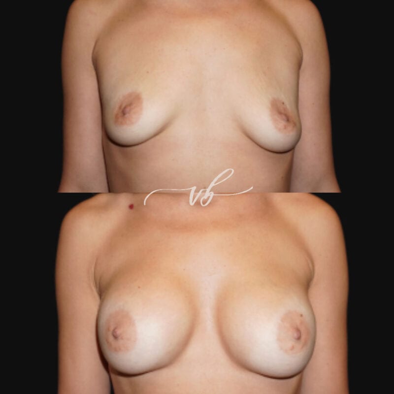 Breast augmentation before and after 2
