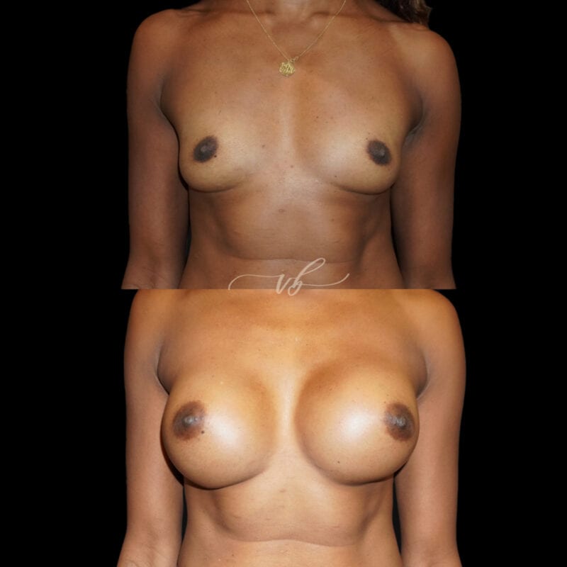 Breast augmentation before and after 3