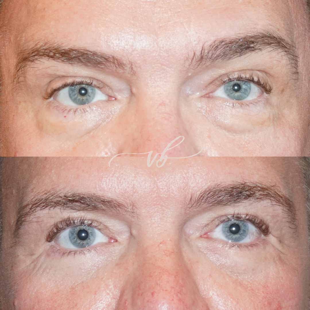 Eyelid surgery before and after 1