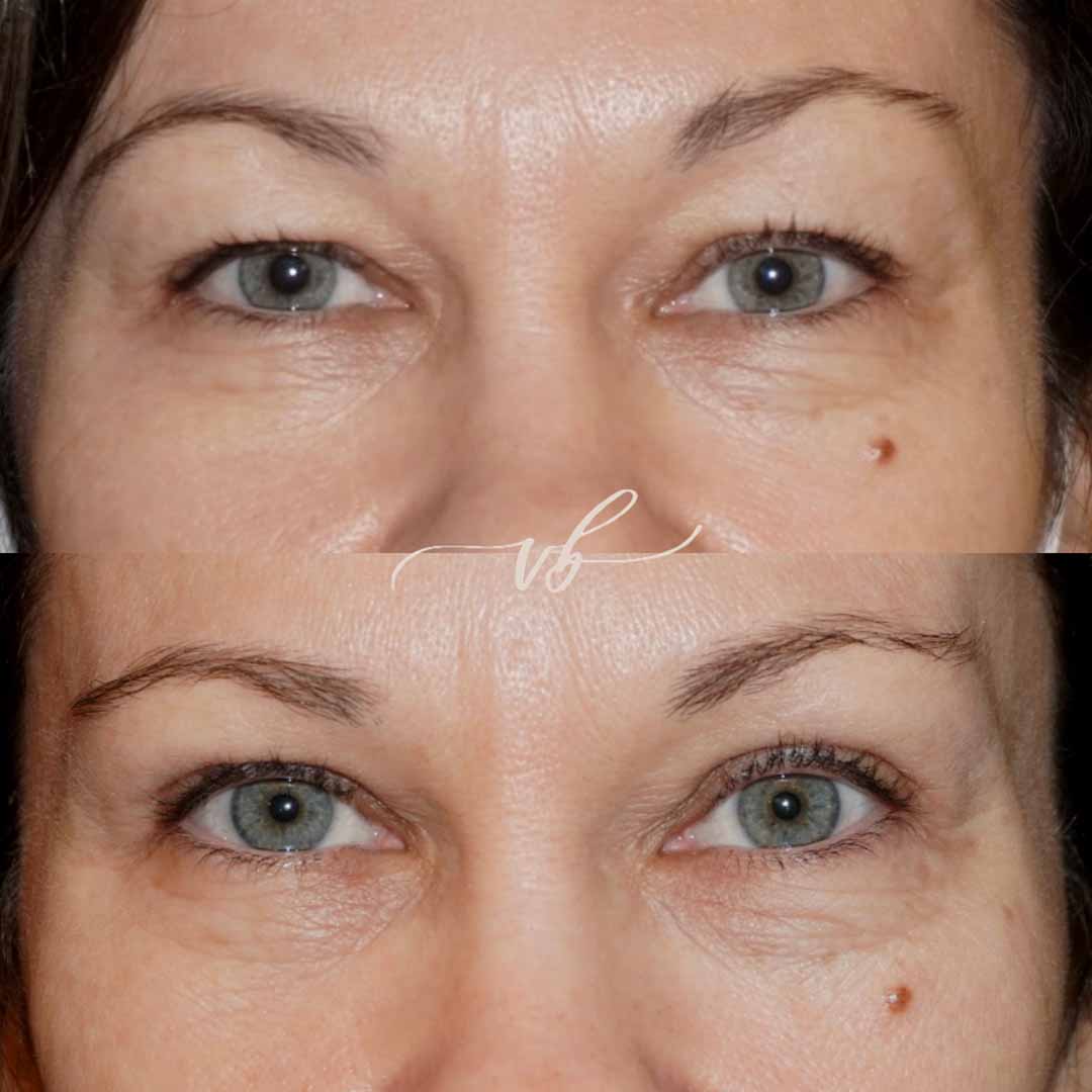 Eyelid surgery before and after 2