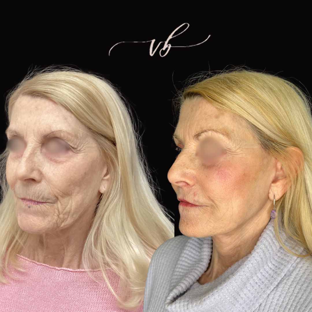 Before and after results after a successful facelift in Plano