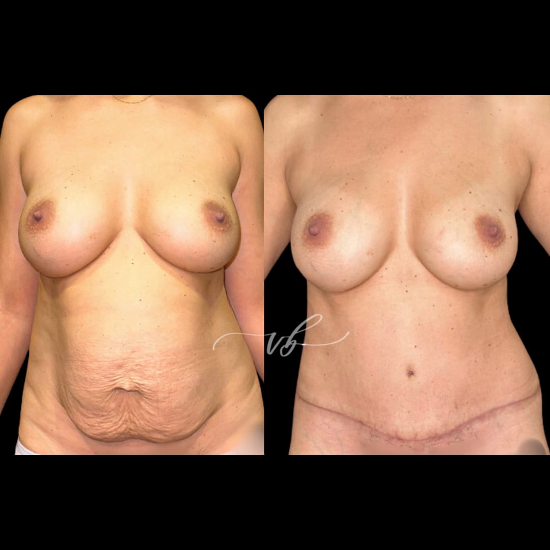 Abdominoplasty before and after