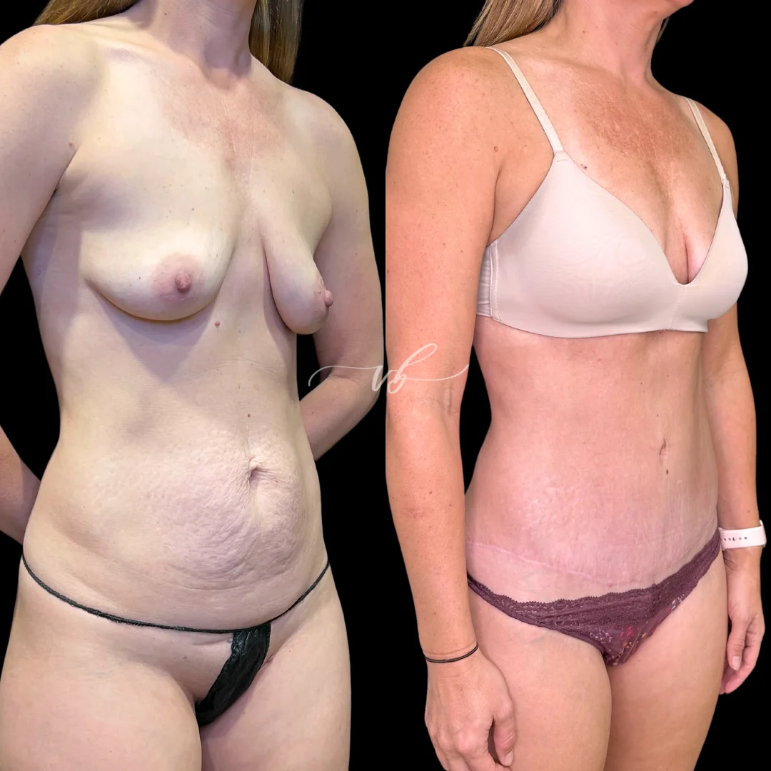 Abdominoplasty before and after