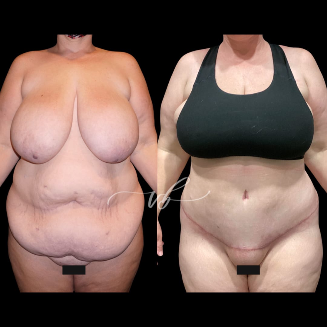 Abdominoplasty before and after