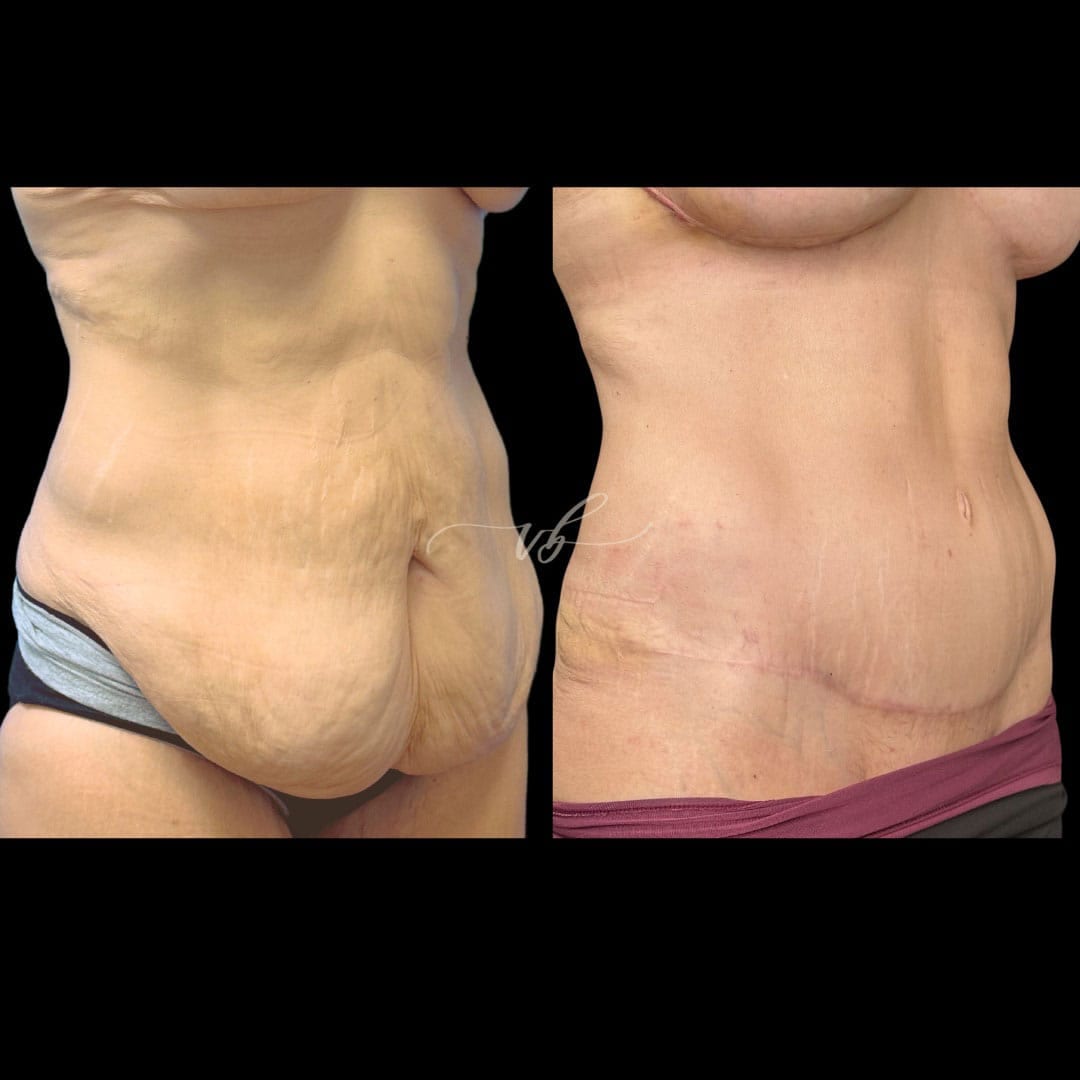 Abdominoplasty before and after