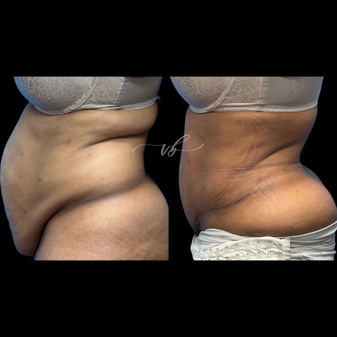 Abdominoplasty before and after