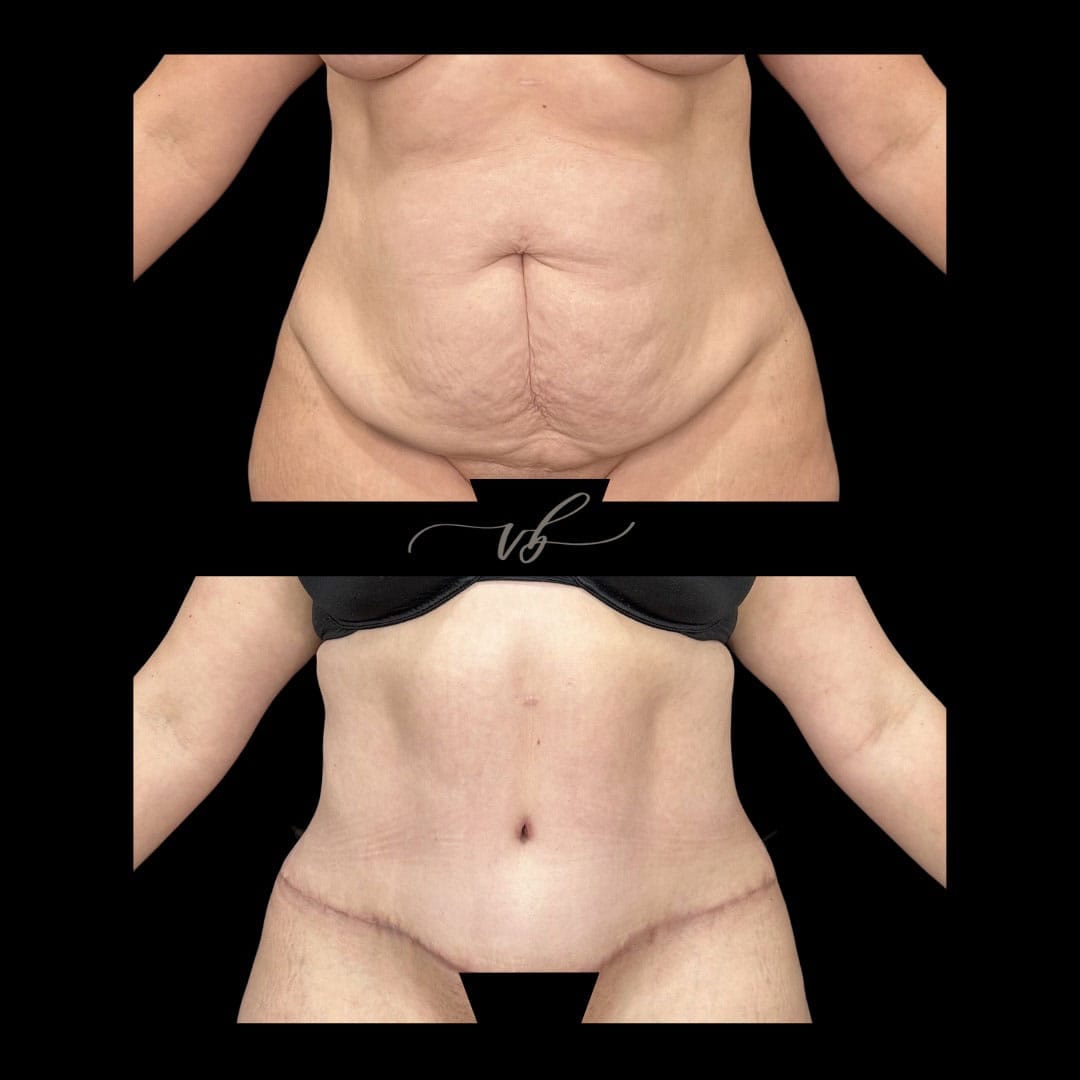 Abdominoplasty before and after
