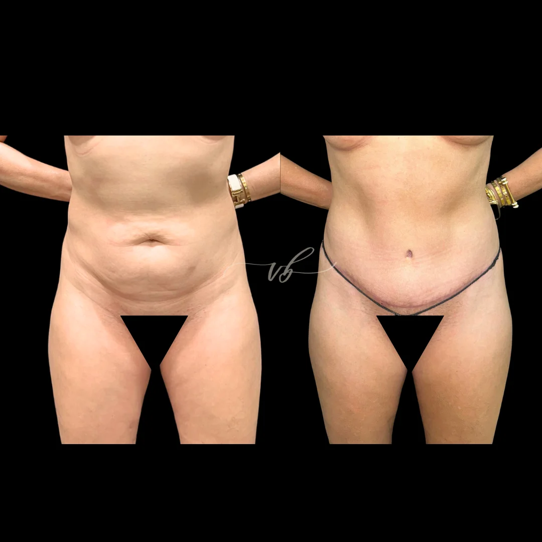 Abdominoplasty before and after