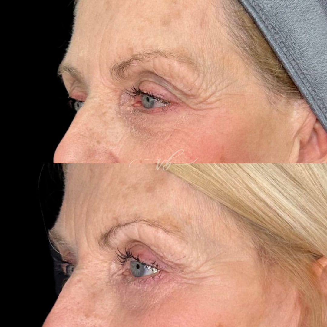 Blepharoplasty before and after