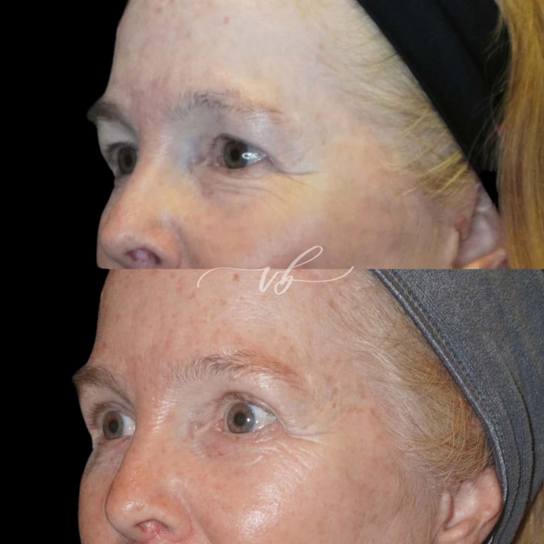 Blepharoplasty before and after