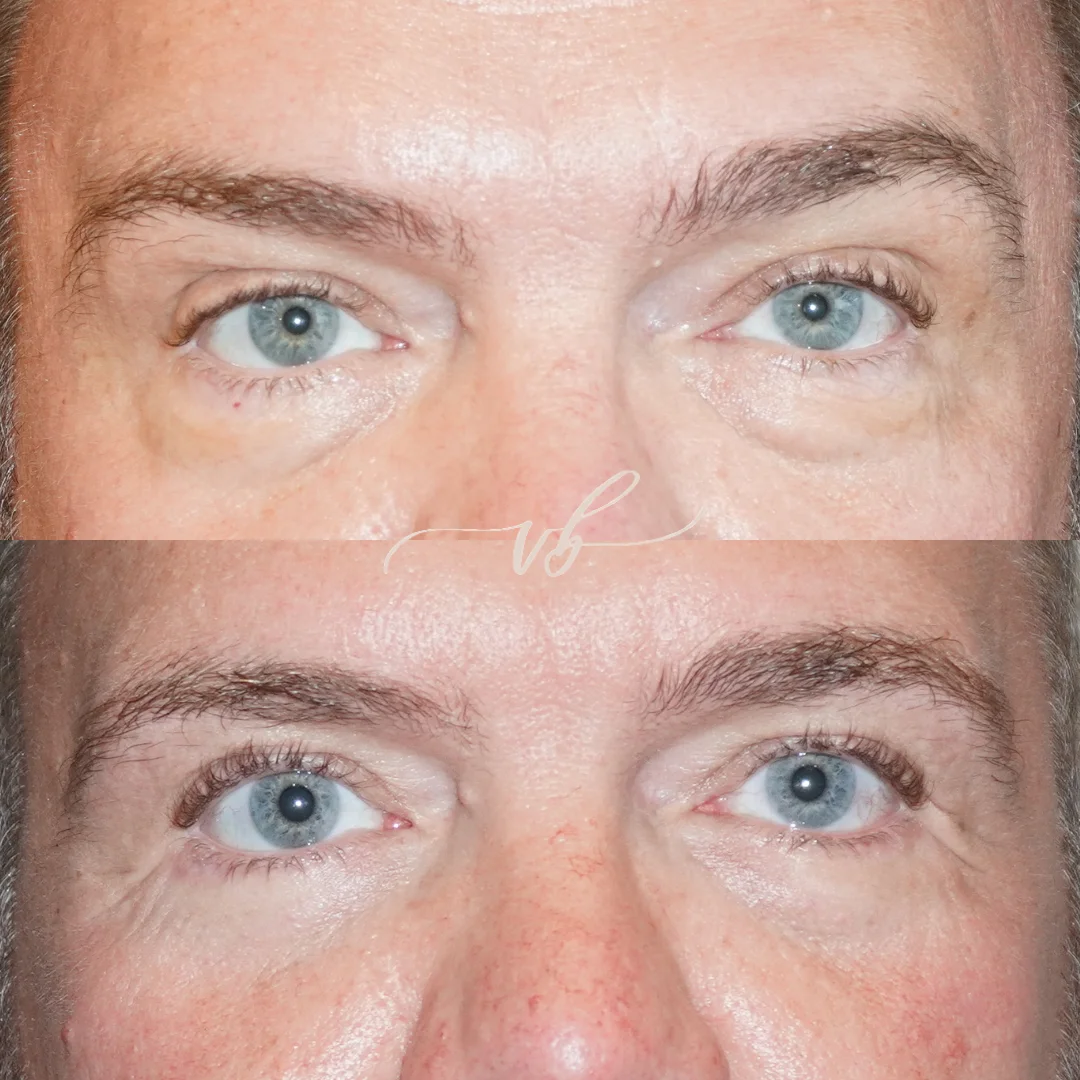 Blepharoplasty before and after