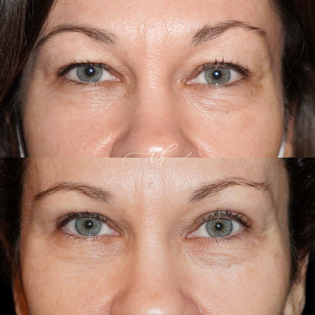 Blepharoplasty before and after