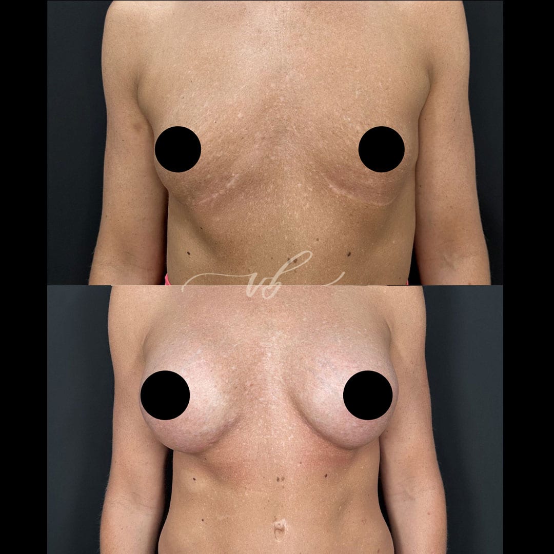 Breast Augmentation before and after
