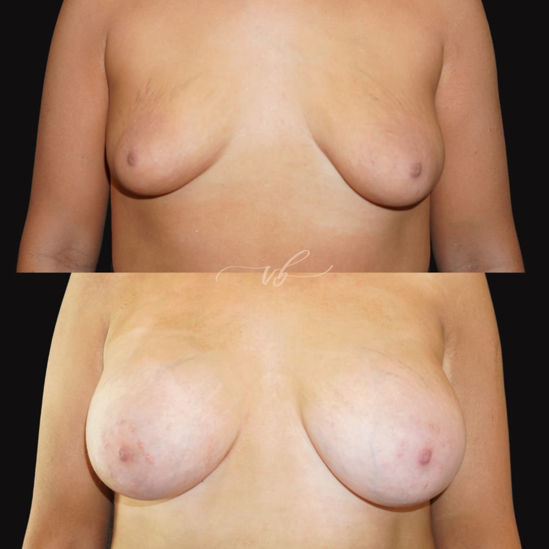 Breast Augmentation before and after