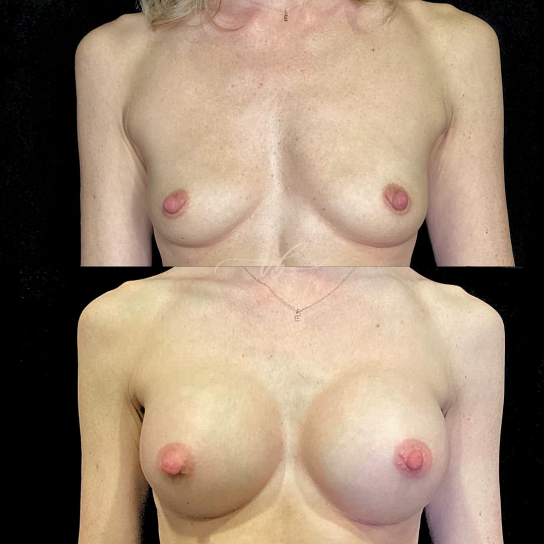 Breast Augmentation before and after