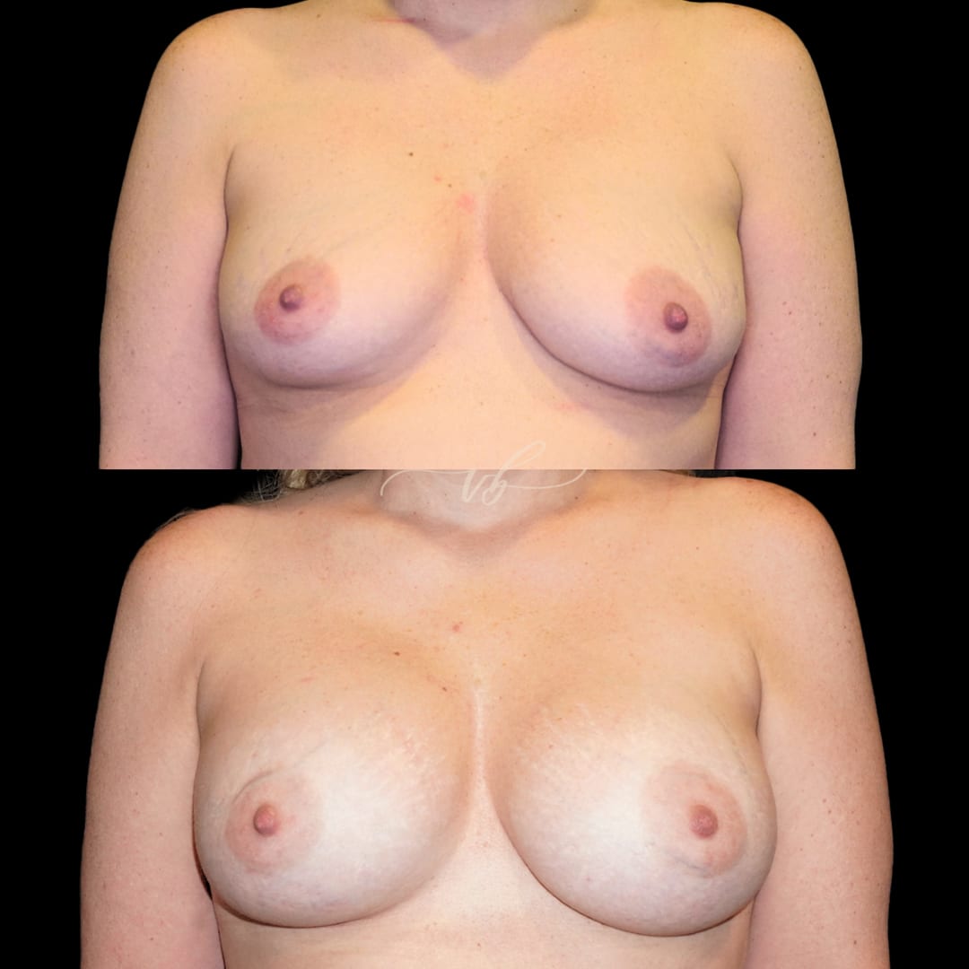 Breast Augmentation before and after