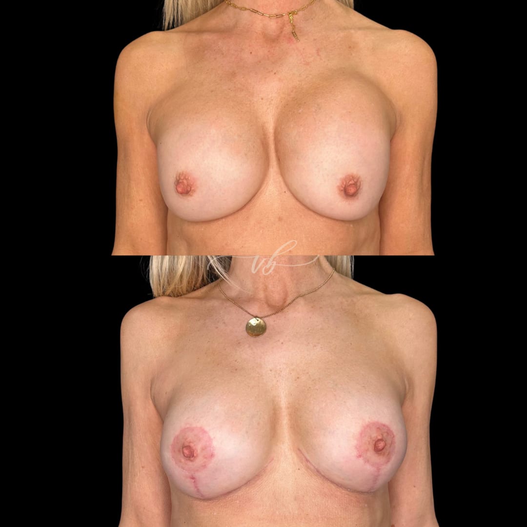 Breast Augmentation before and after