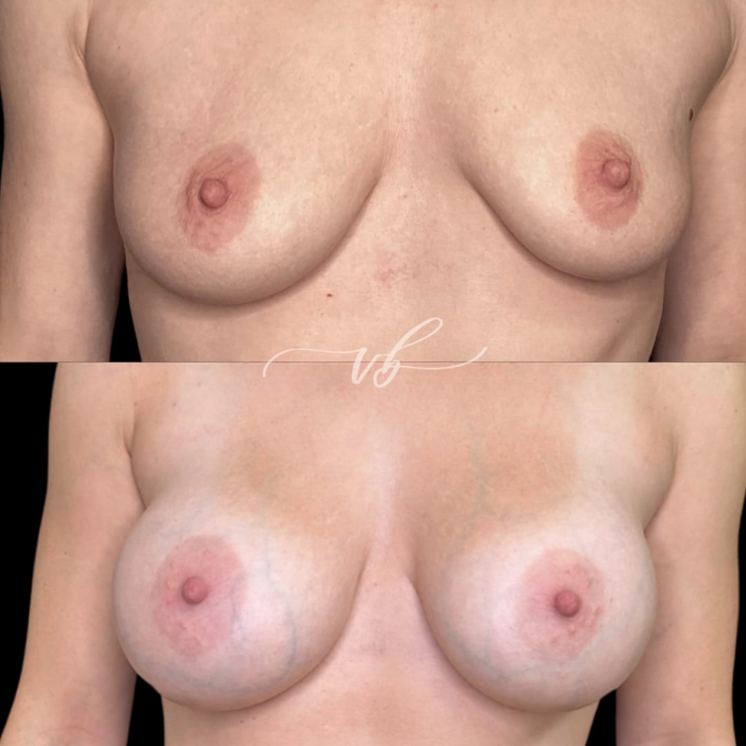 Breast Augmentation before and after