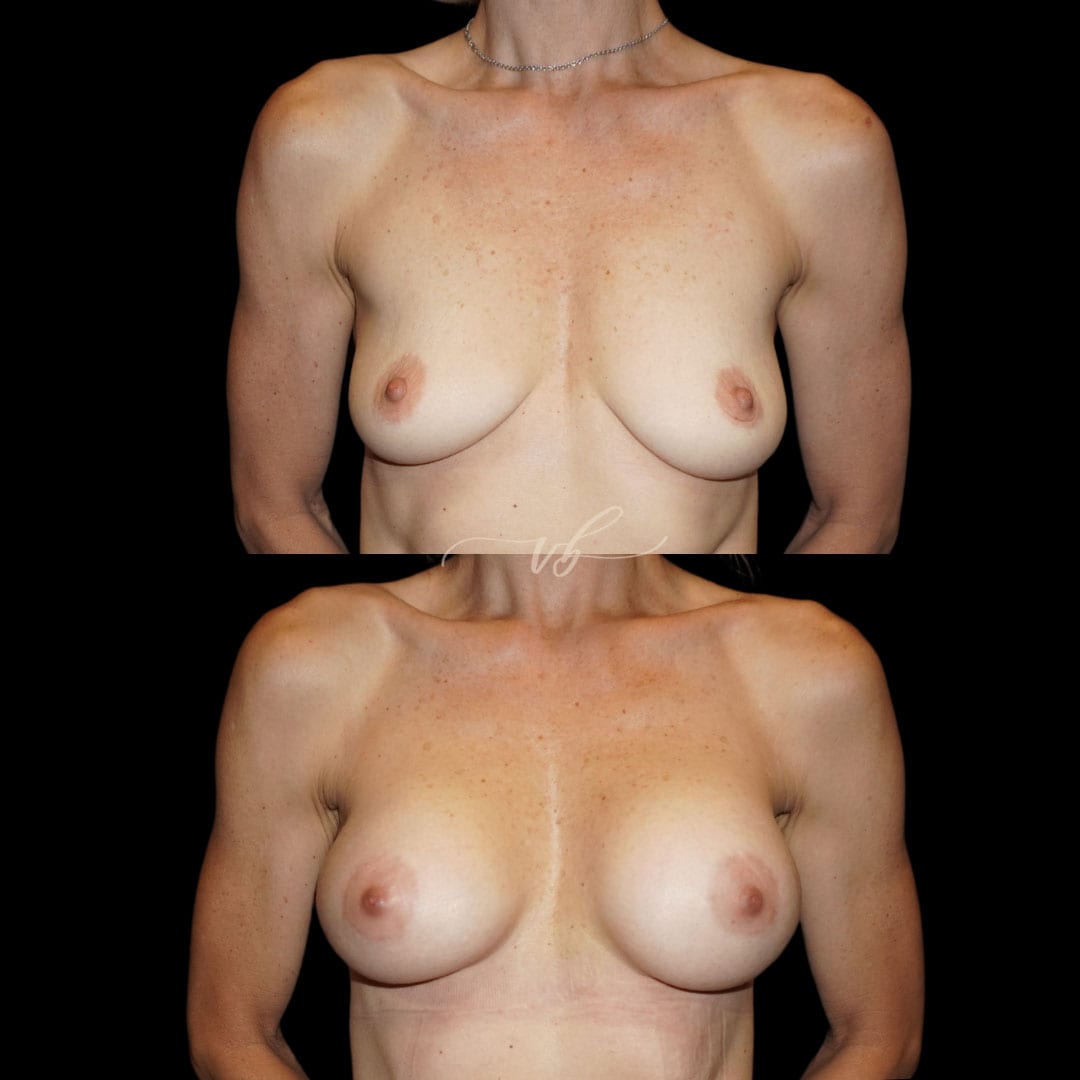 Breast Augmentation before and after