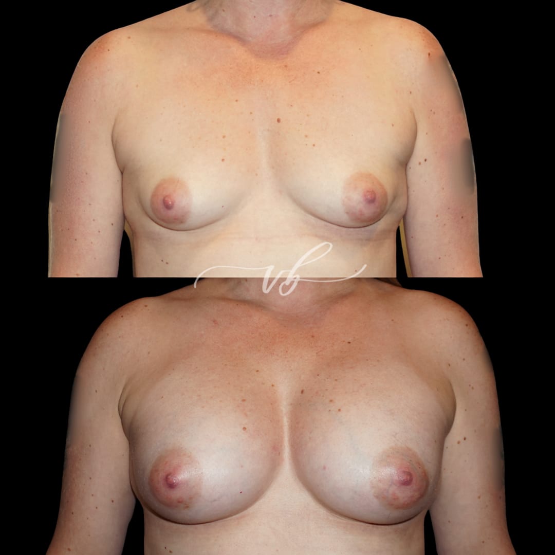 Breast Augmentation before and after