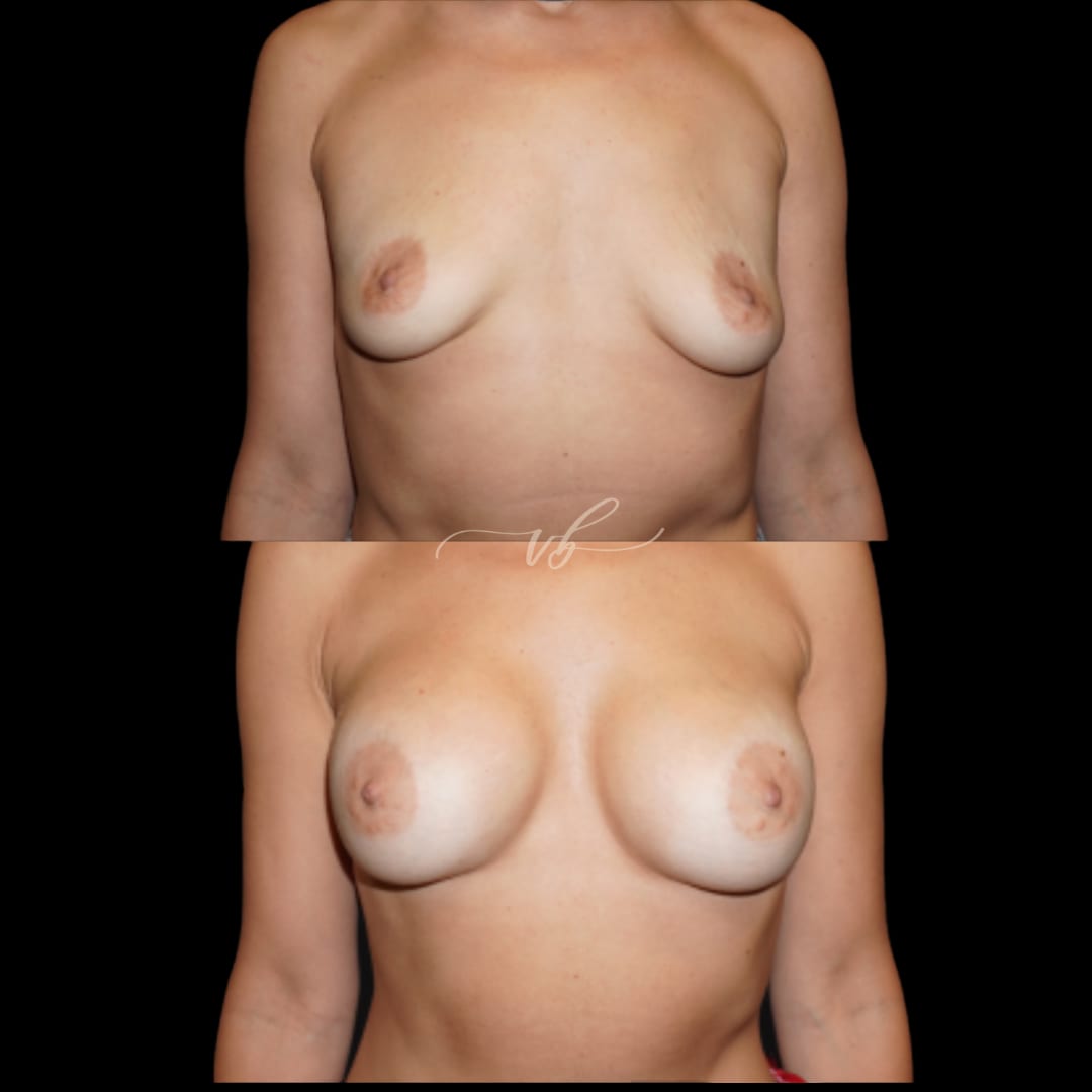Breast Augmentation before and after