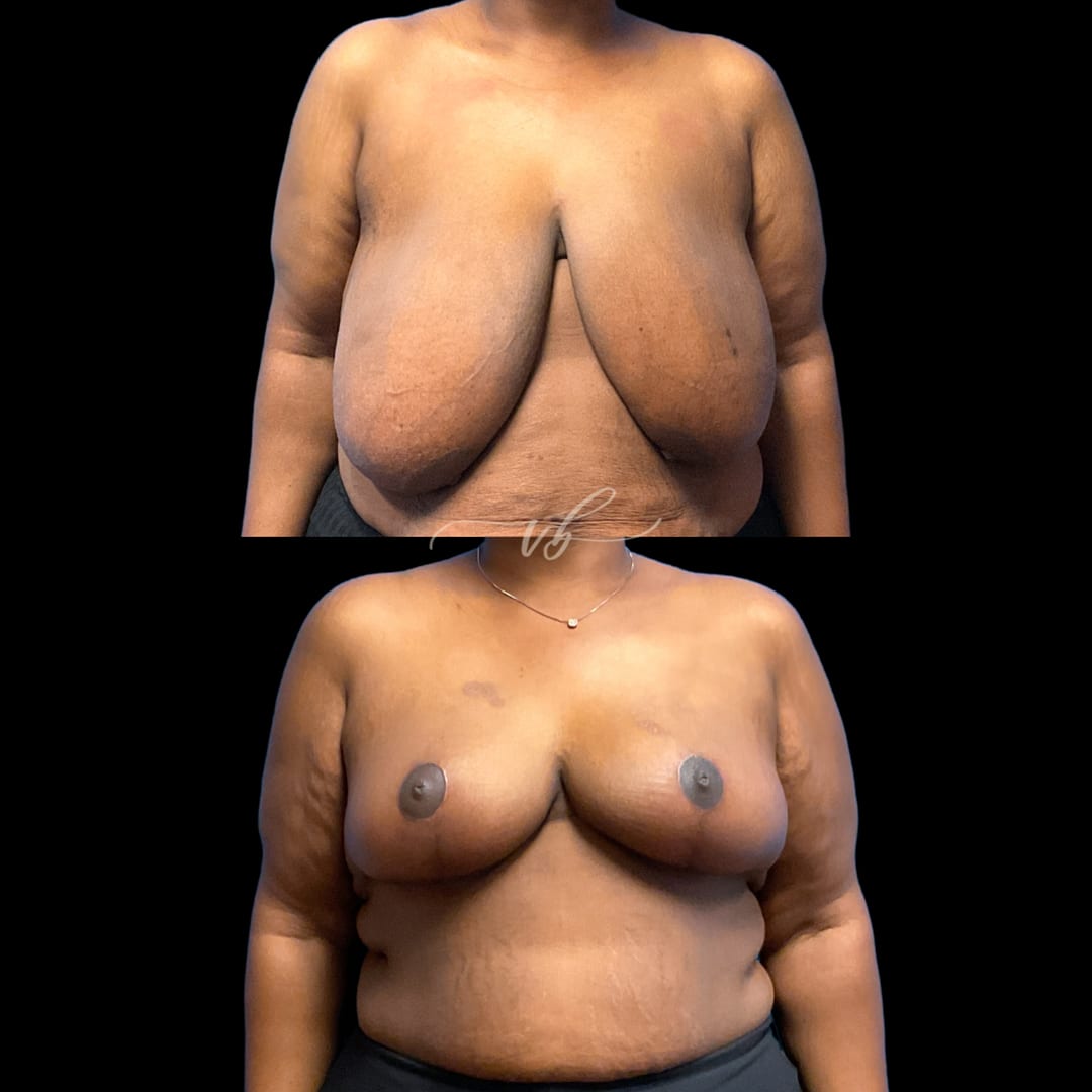 Breast Reduction & Lift before and after
