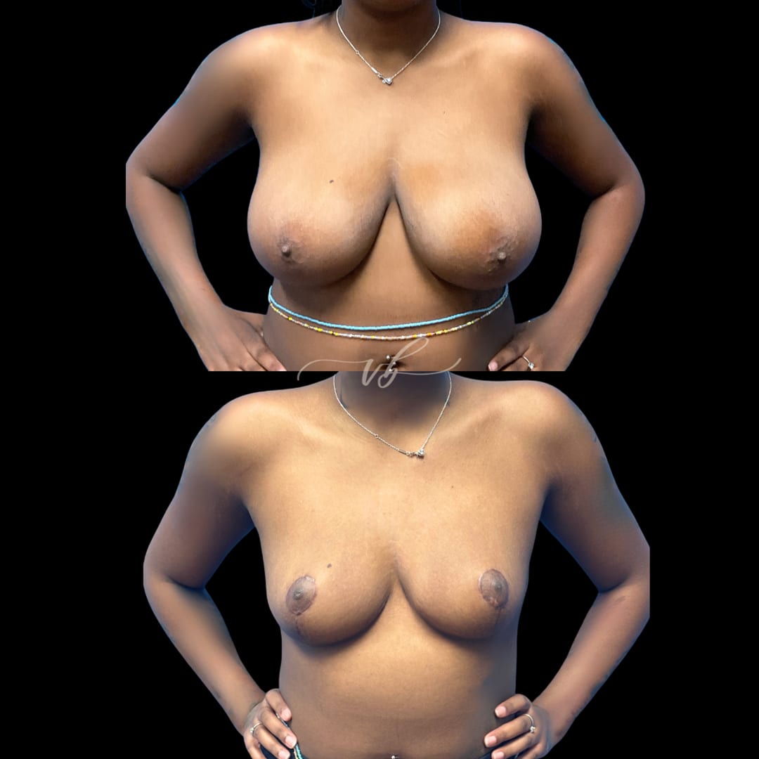 Breast Reduction & Lift before and after