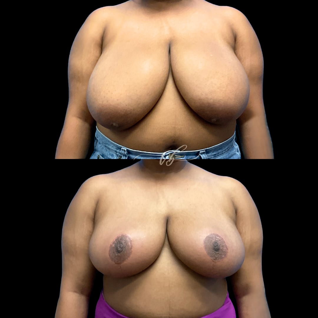 Breast Reduction & Lift before and after