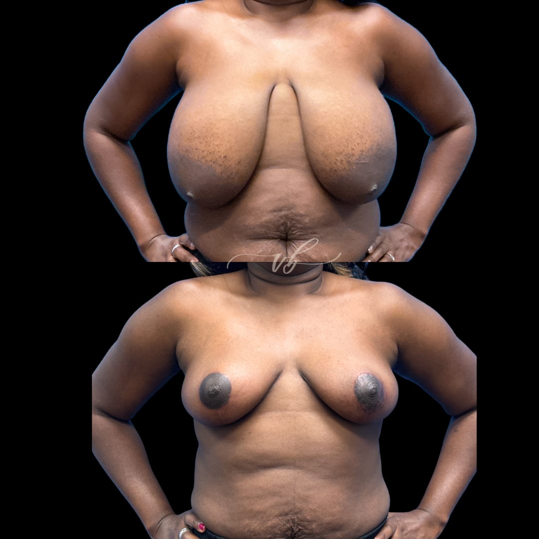 Breast Reduction & Lift before and after