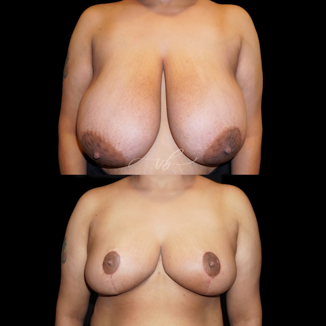 Breast Reduction & Lift before and after