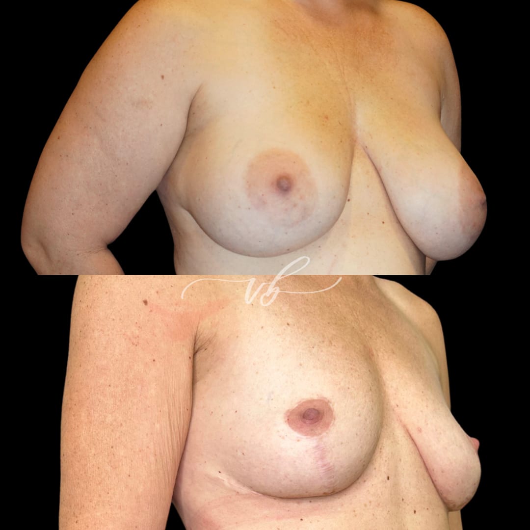 Breast Reduction & Lift before and after