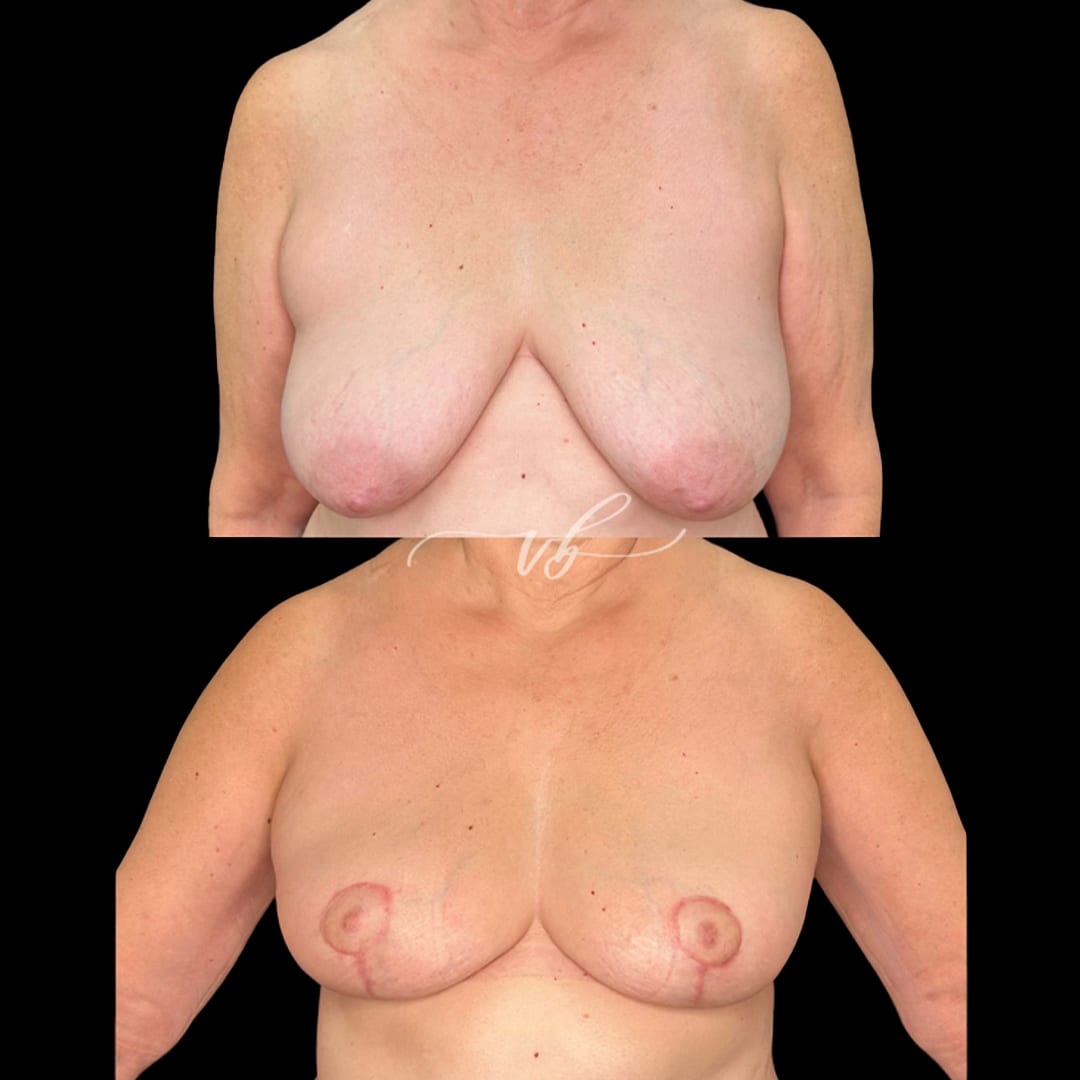 Breast Reduction & Lift before and after