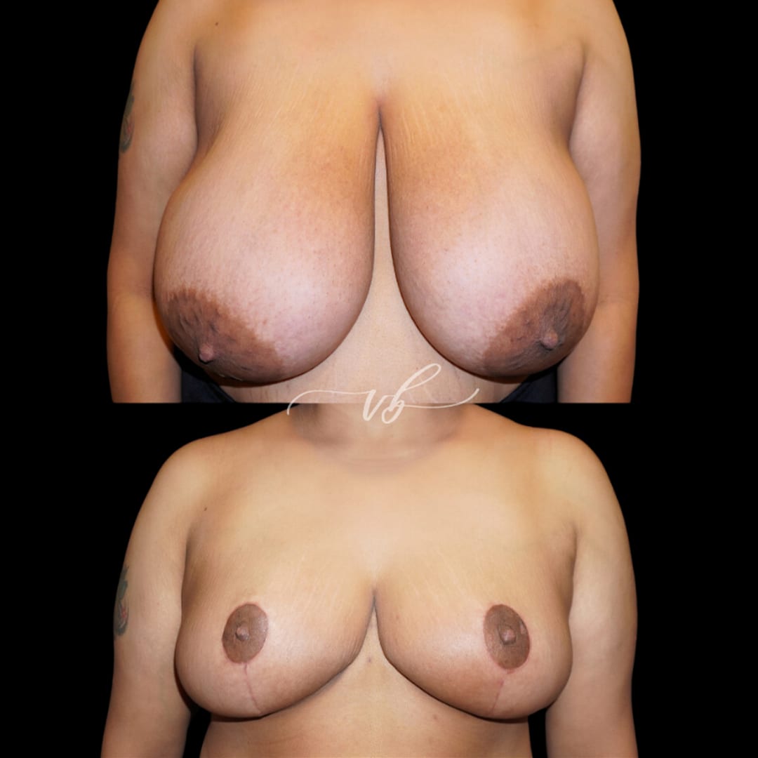 Breast Reduction & Lift before and after