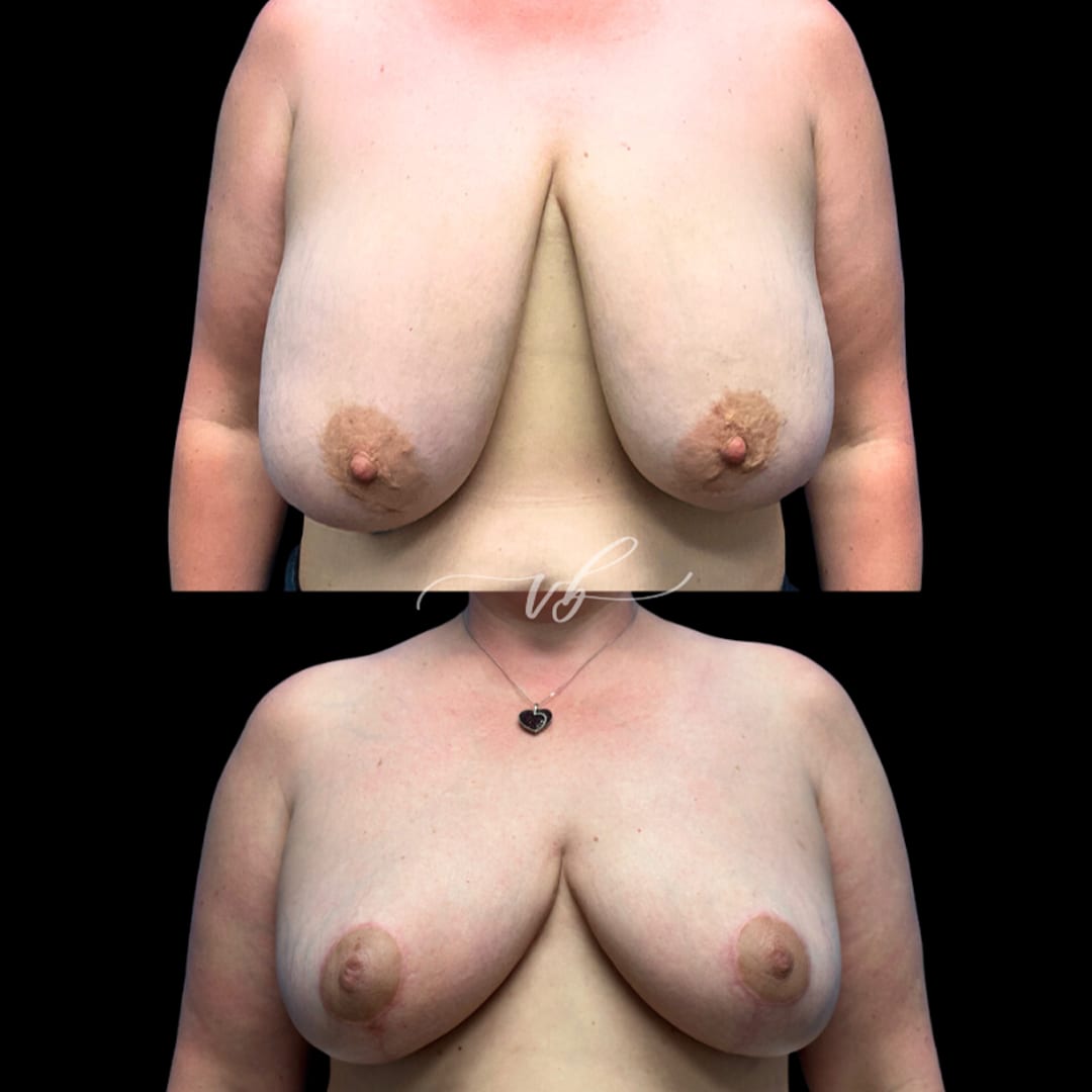 Breast Reduction & Lift before and after