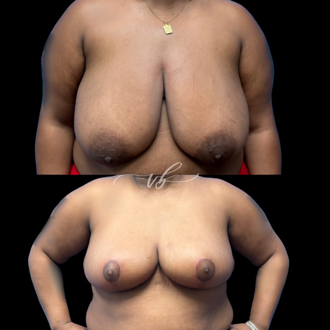 Breast Reduction & Lift before and after