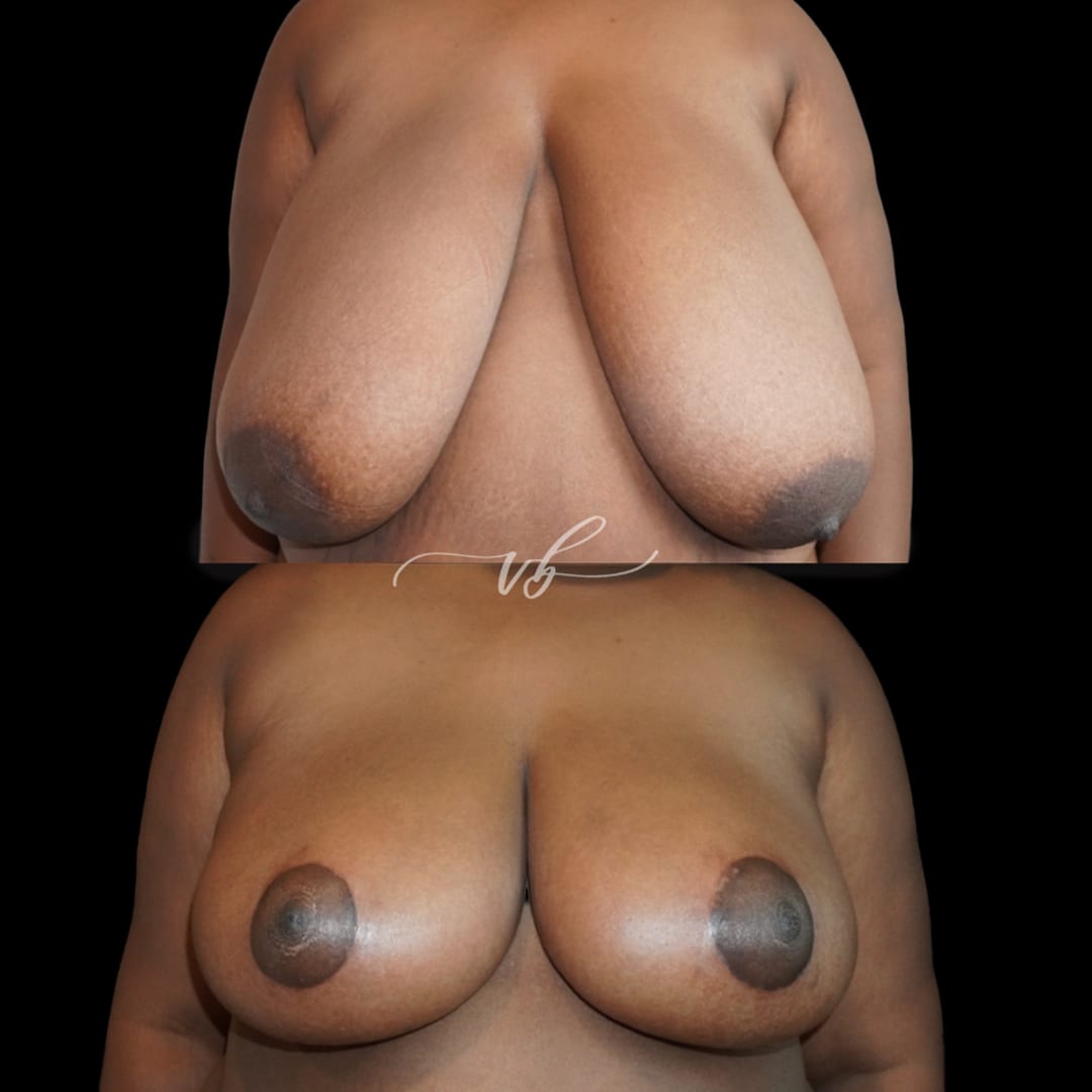 Breast Reduction & Lift before and after