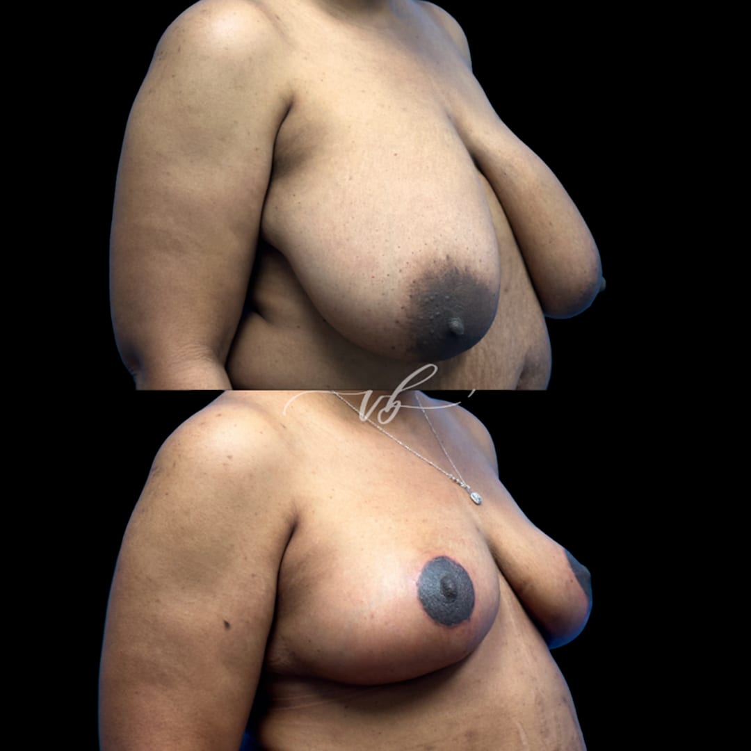 Breast Reduction & Lift before and after