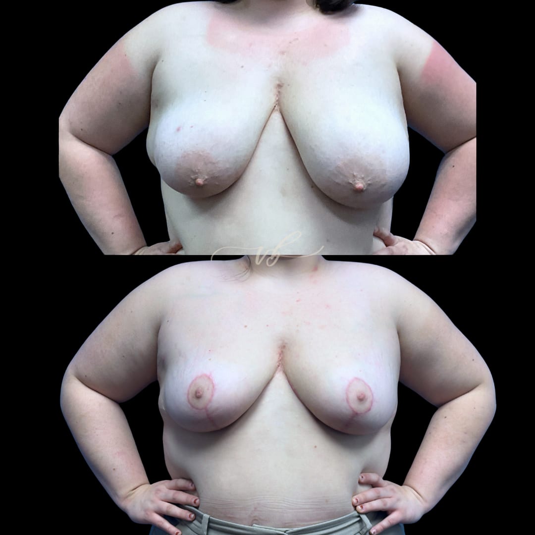 Breast Reduction & Lift before and after