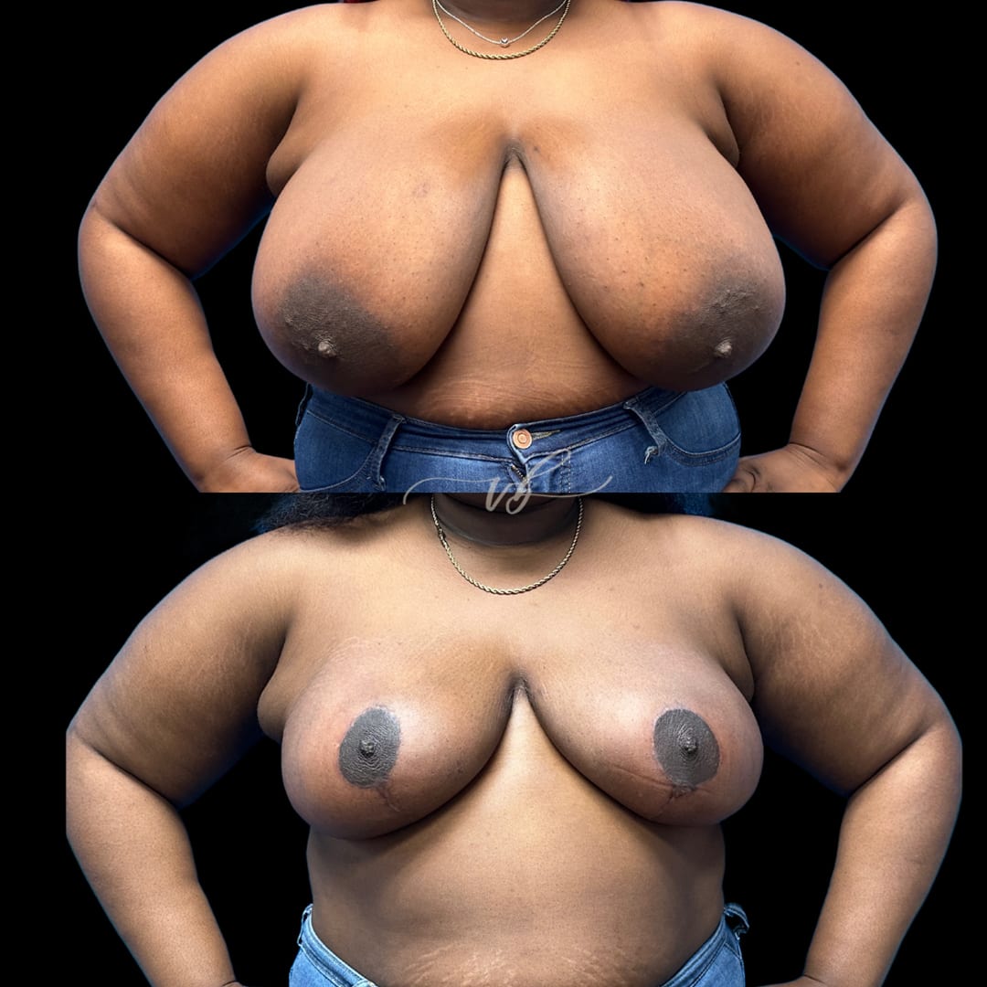 Breast Reduction & Lift before and after