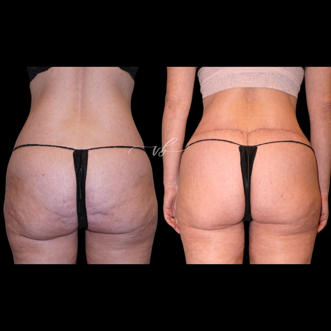 Butt Lift before and after