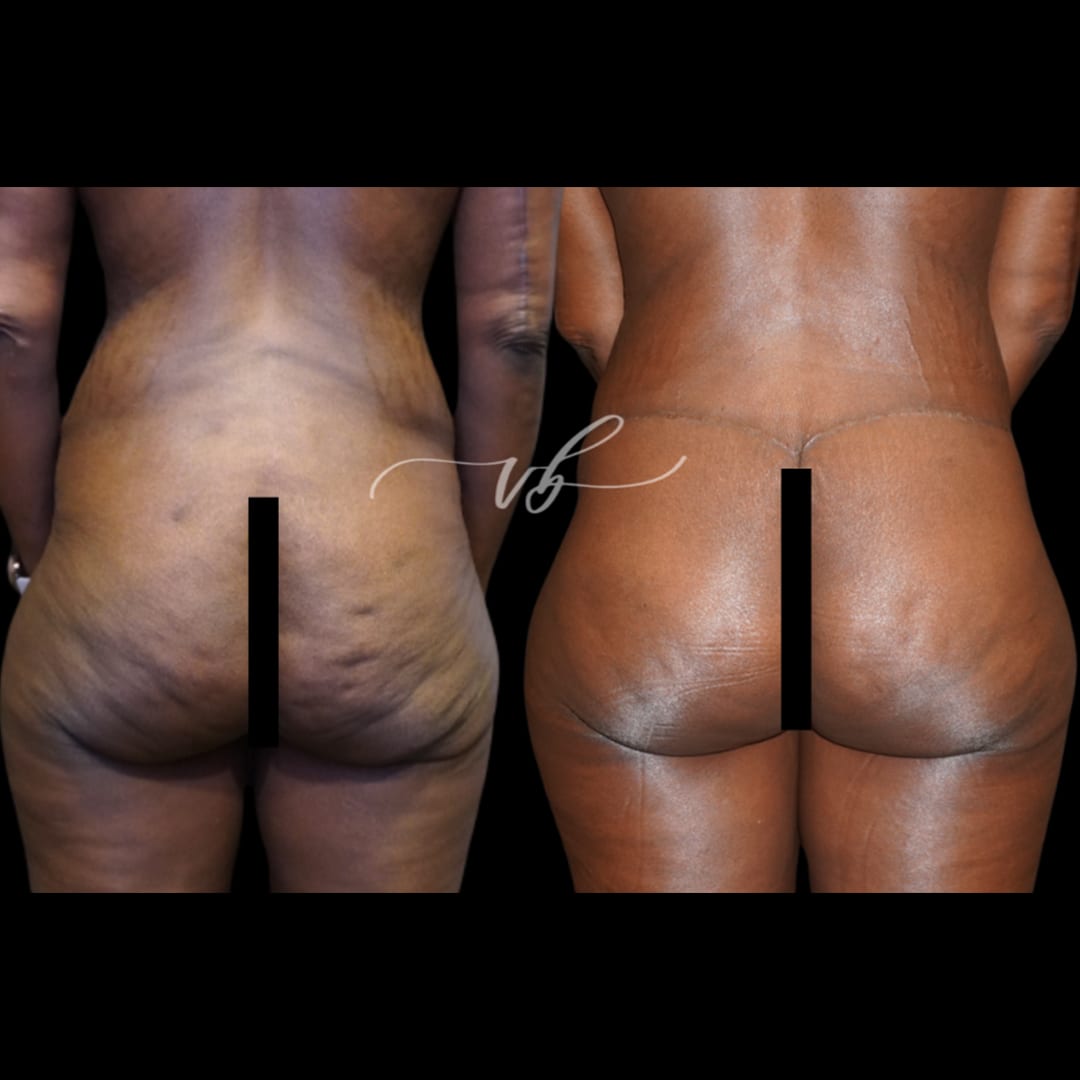 Butt Lift before and after