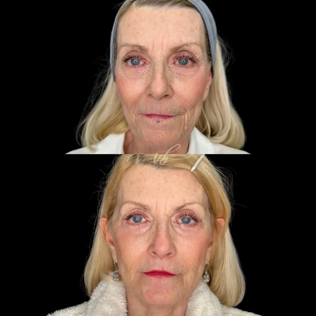 Facelift before and after