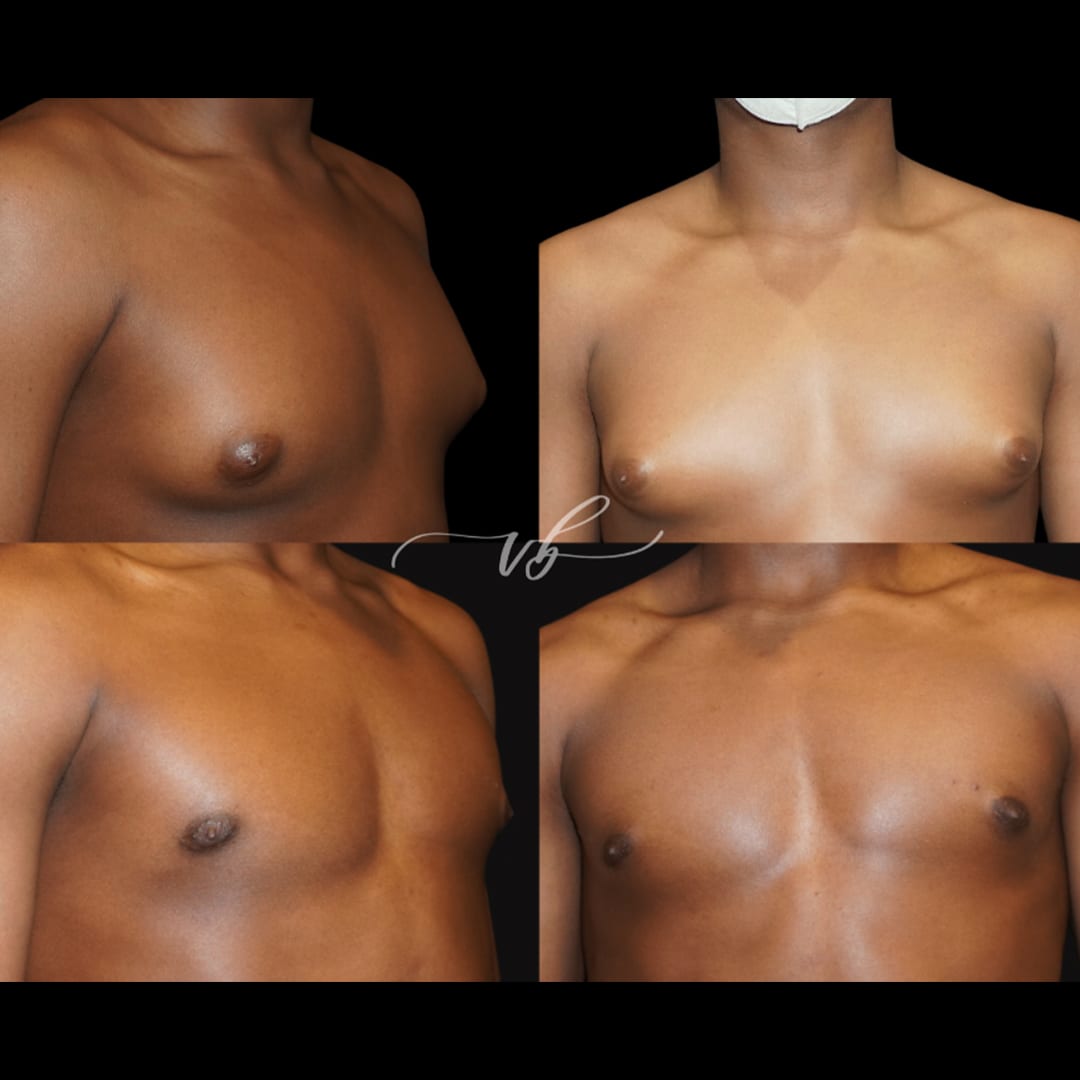 Gynecomastia Reduction before and after