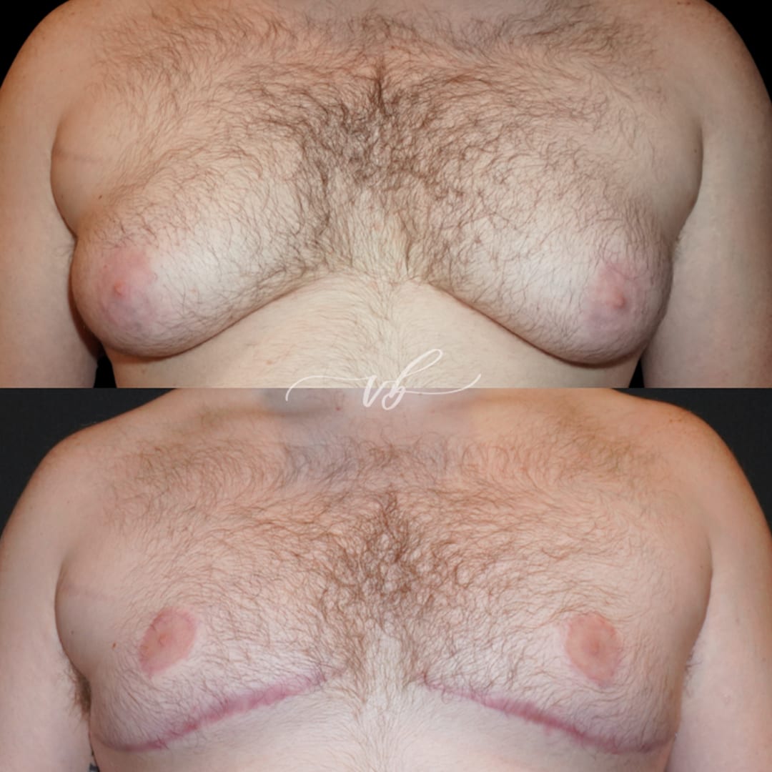 Gynecomastia Reduction before and after