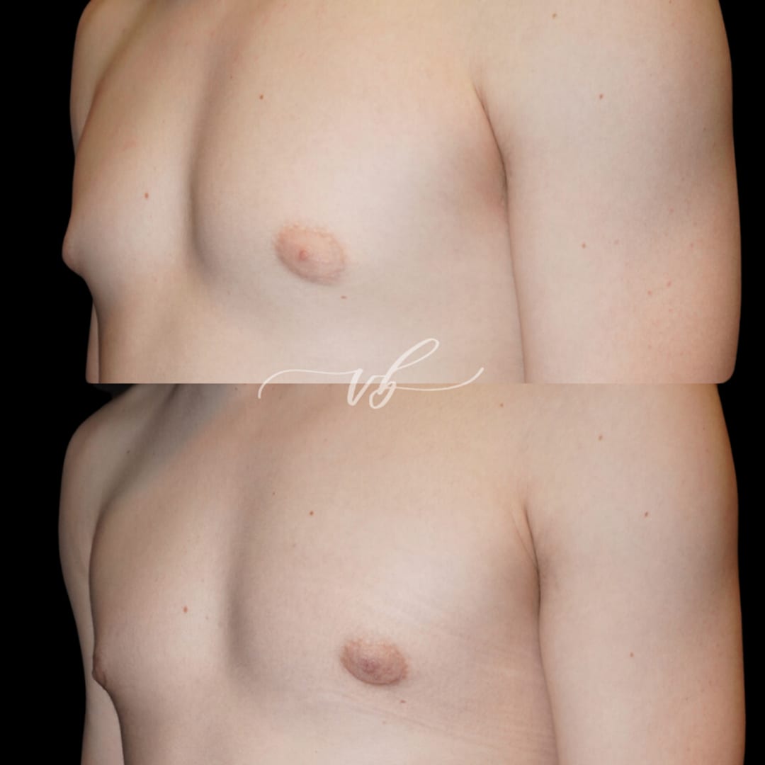 Gynecomastia Reduction before and after