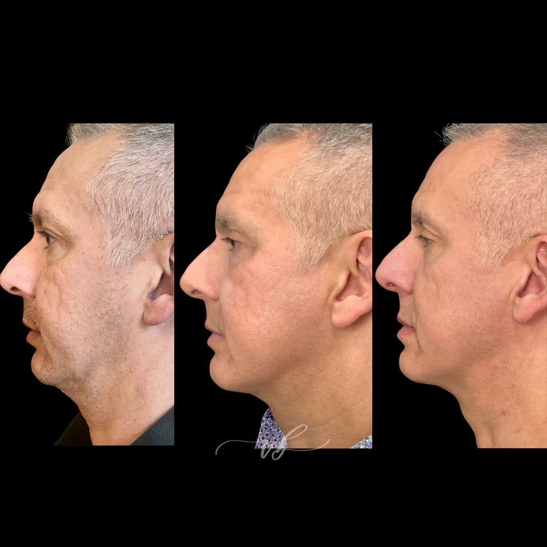 Lasers before and after