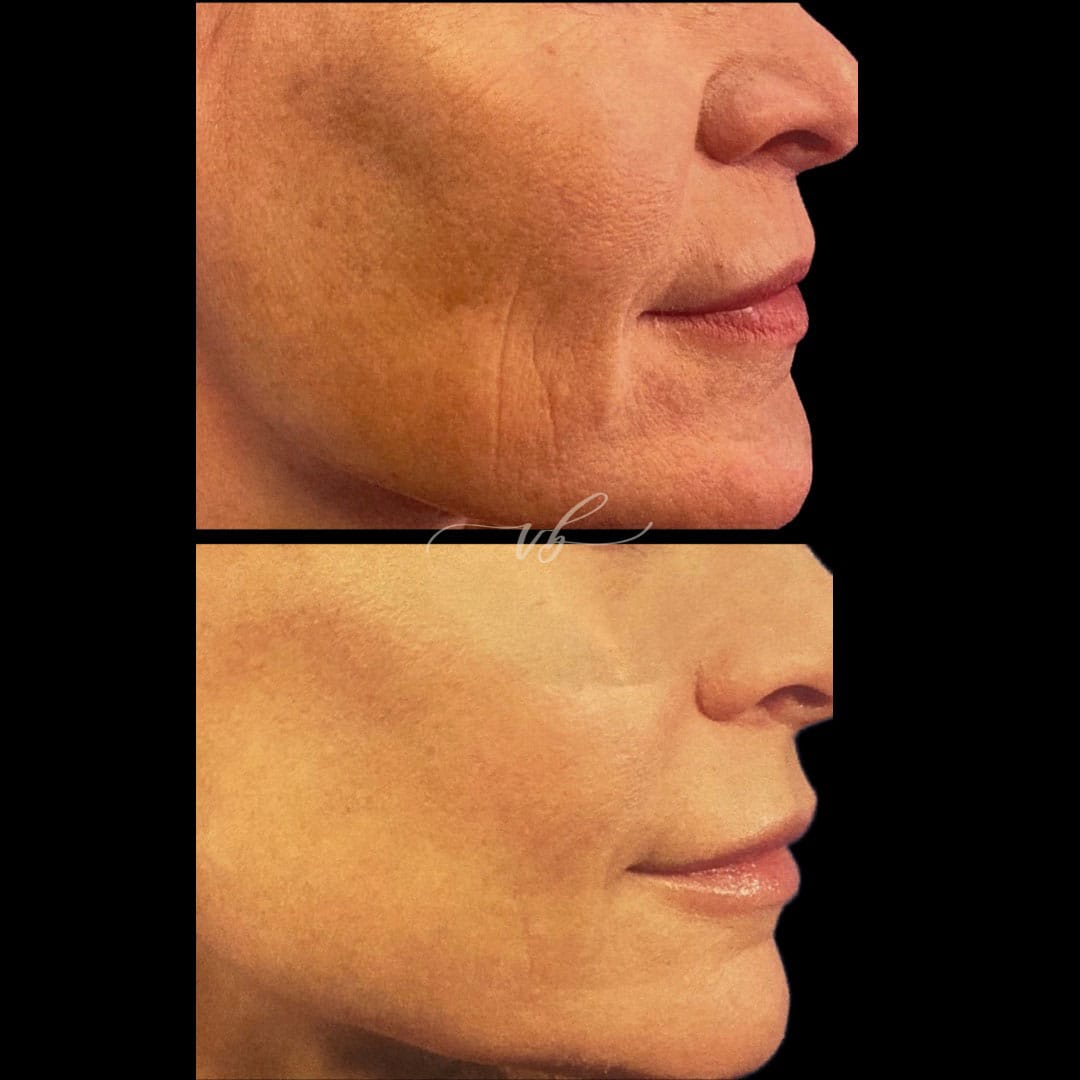 Lasers before and after