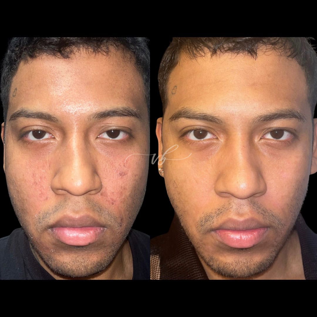Lasers before and after