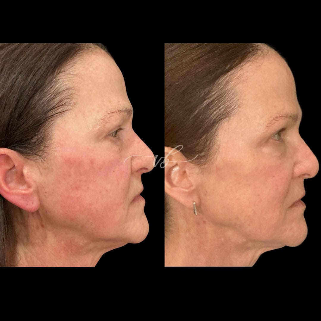 Lasers before and after